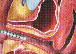 laser rejuvenescimento vaginal