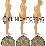 Osteoporose na menopausa