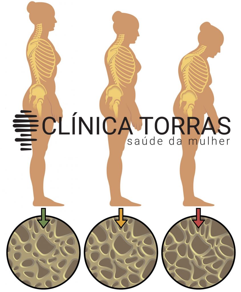 Osteoporose na menopausa