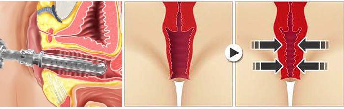 laser vaginal