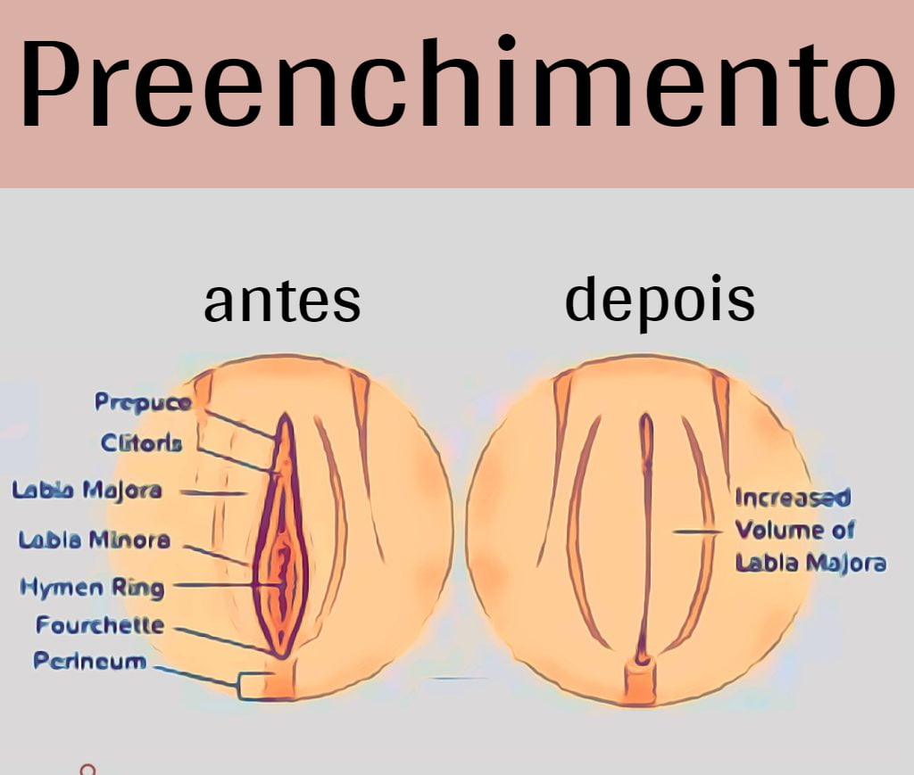 preenchimento intimo antes e depois