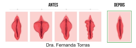 labioplastia antes e depois