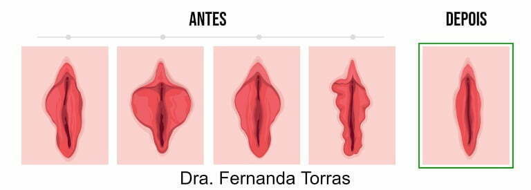 ninfoplastia antes depois