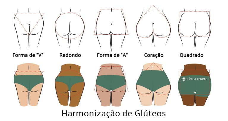 harmonização de glúteos
