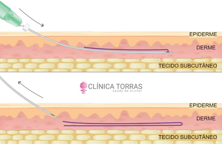 fios de pdo intimo preço