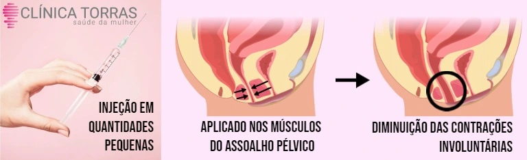 botox intimo