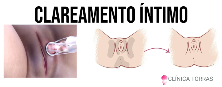 clareamento intimo