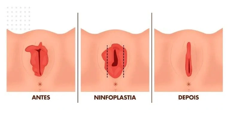 labioplastia